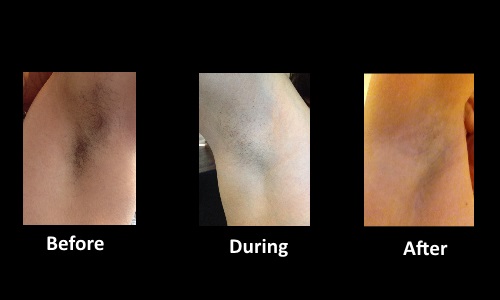 Before During and After picture