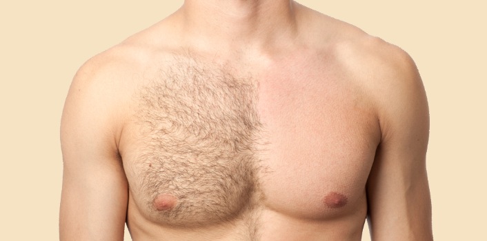 Image of Mens IPL Treatment
